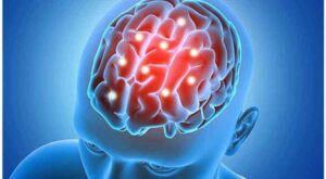 Lee más sobre el artículo Avanza Cuba en ensayo clínico de fármaco contra el Alzheimer