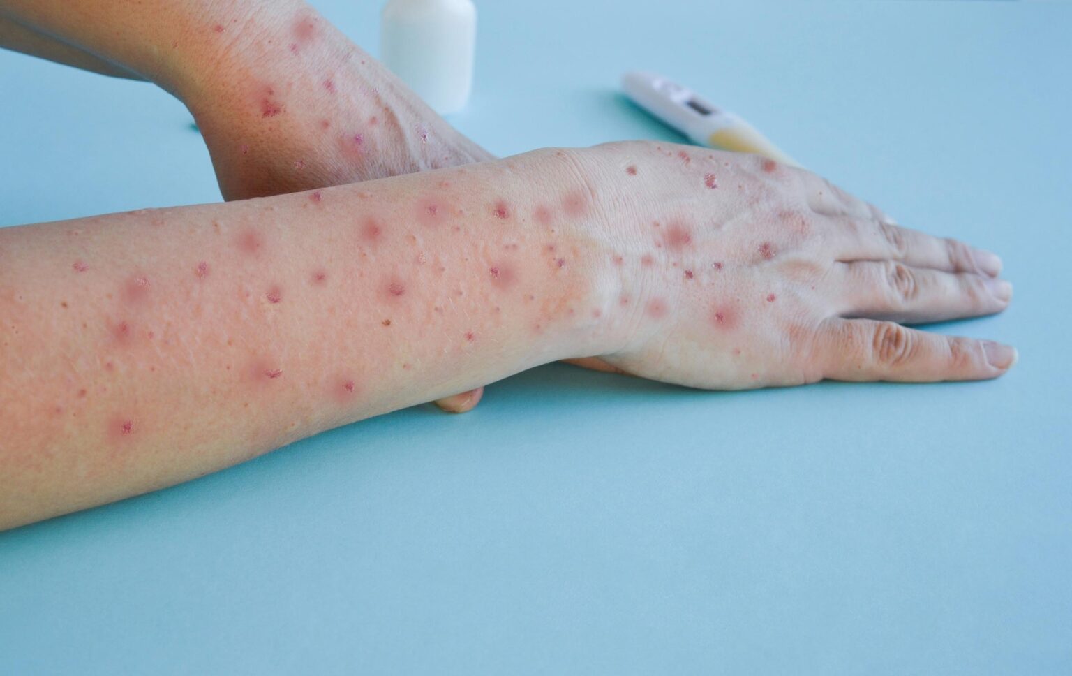 En este momento estás viendo Declara OMS a virus de viruela símica como emergencia sanitaria