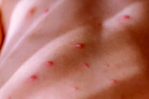 Lee más sobre el artículo Cuba redoubles epidemiological vigilance against monkeypox