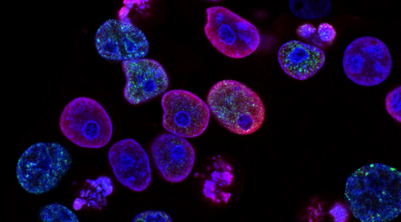 En este momento estás viendo Científicos desarrollan tecnología capaz de detectar algunos tipos de cáncer con análisis de orina