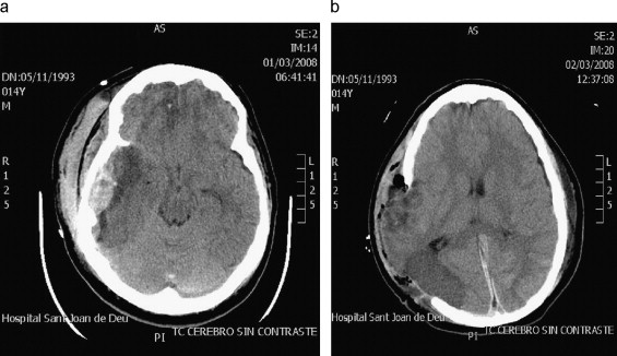 En este momento estás viendo Avances en la neurocirugía avileña
