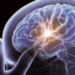 Workshop on Cerebrovascular Diseases Held in Morón