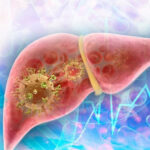 Autoridades sanitarias investigan posible brote de hepatitis en Ciego de Ávila