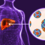 Evolución favorable de casos de hepatitis en Ciego de Ávila