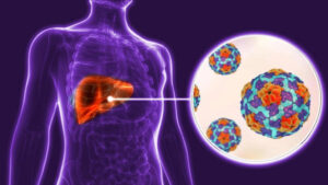 Evolución favorable de casos de hepatitis en Ciego de Ávila